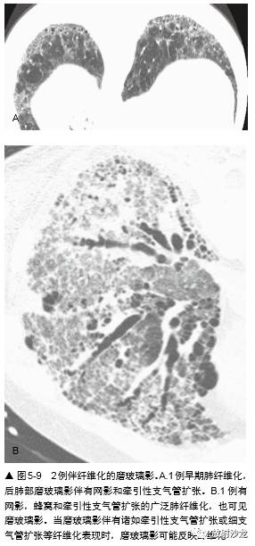 HRCT:磨玻璃影的意义 HRCT:磨玻璃影的意义
