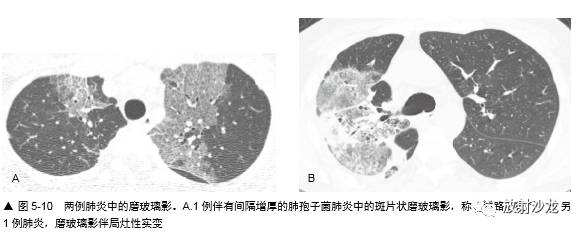 HRCT:磨玻璃影的意义 HRCT:磨玻璃影的意义