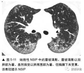 HRCT:磨玻璃影的意义 HRCT:磨玻璃影的意义
