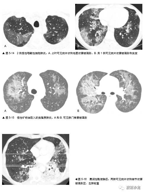 HRCT:磨玻璃影的意义 HRCT:磨玻璃影的意义