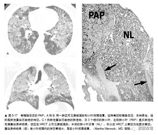 HRCT:磨玻璃影的意义 HRCT:磨玻璃影的意义
