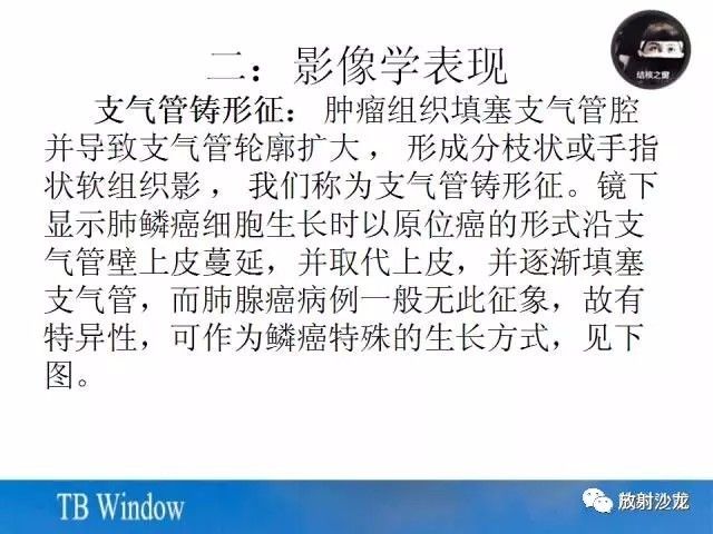 【PPT】周围型肺鳞癌的影像征象及鉴别诊断