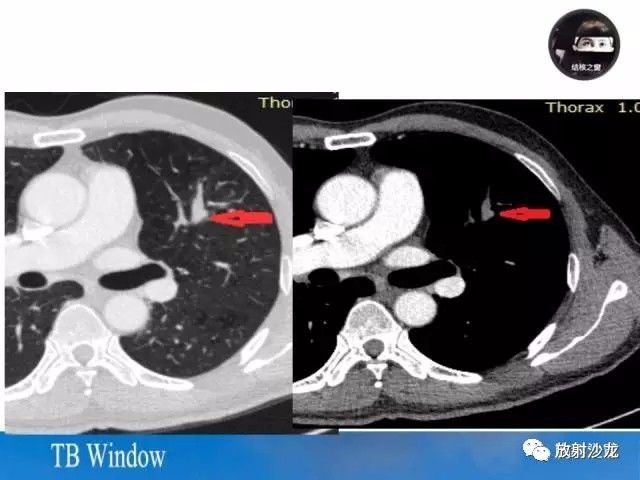 【PPT】周围型肺鳞癌的影像征象及鉴别诊断