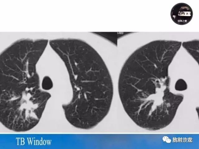 【PPT】周围型肺鳞癌的影像征象及鉴别诊断