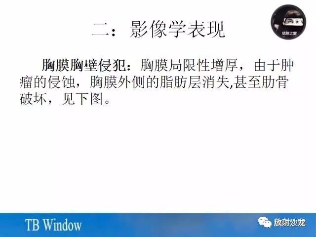 【PPT】周围型肺鳞癌的影像征象及鉴别诊断