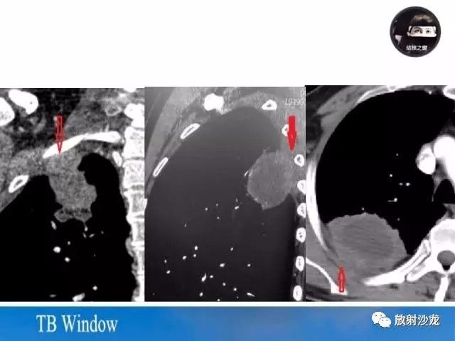 【PPT】周围型肺鳞癌的影像征象及鉴别诊断