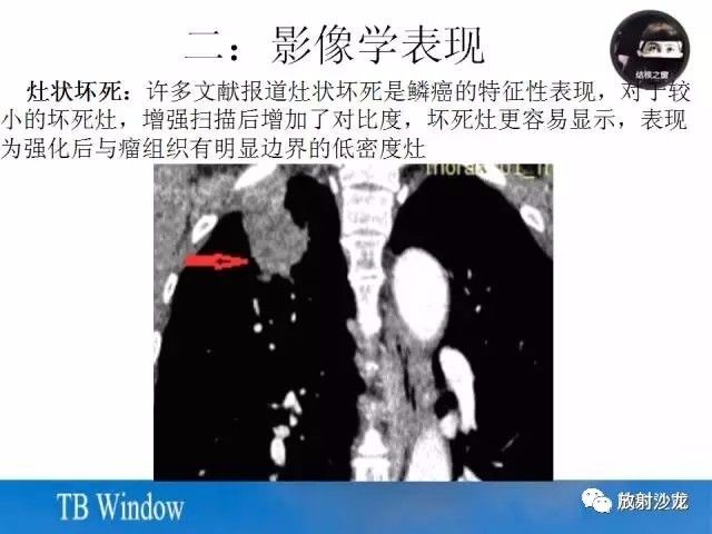 【PPT】周围型肺鳞癌的影像征象及鉴别诊断