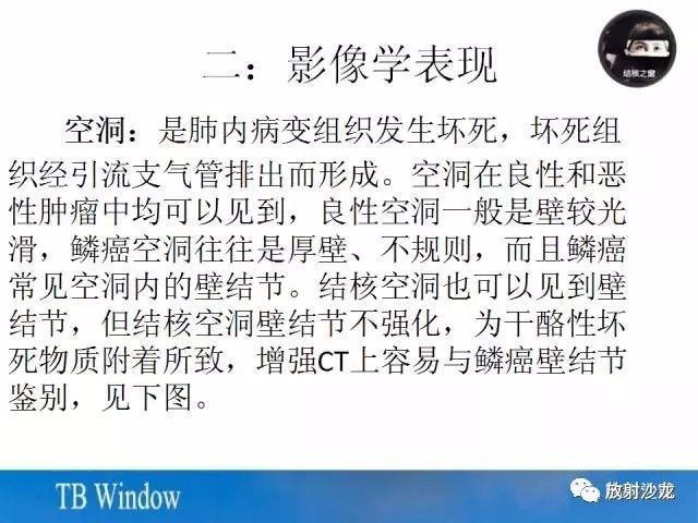 【PPT】周围型肺鳞癌的影像征象及鉴别诊断