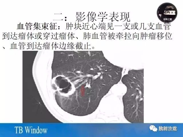 【PPT】周围型肺鳞癌的影像征象及鉴别诊断