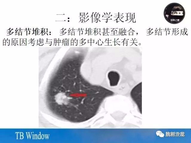 【PPT】周围型肺鳞癌的影像征象及鉴别诊断