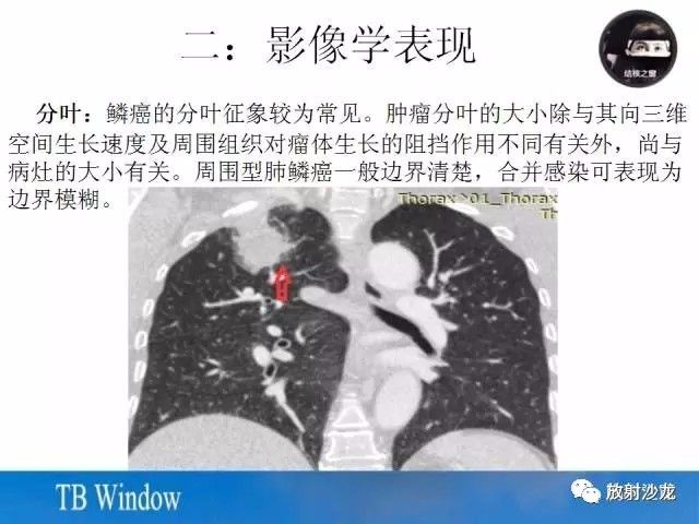 【PPT】周围型肺鳞癌的影像征象及鉴别诊断