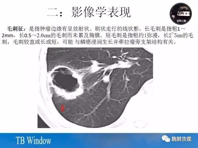 【PPT】周围型肺鳞癌的影像征象及鉴别诊断