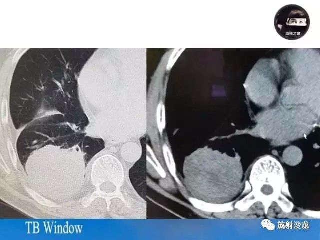 【PPT】周围型肺鳞癌的影像征象及鉴别诊断