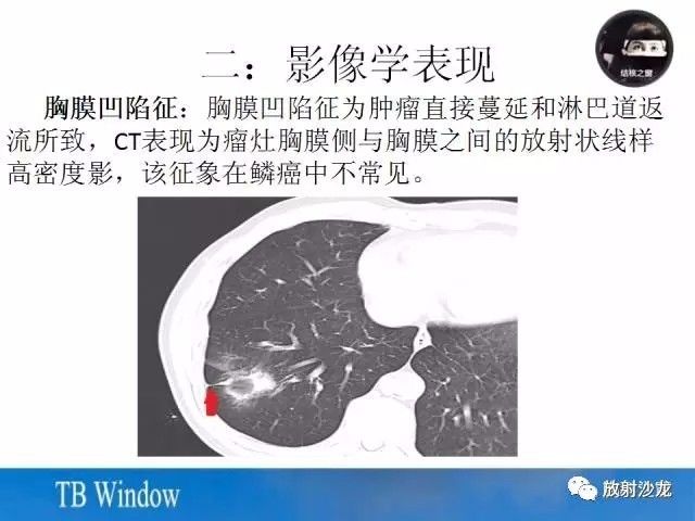 【PPT】周围型肺鳞癌的影像征象及鉴别诊断