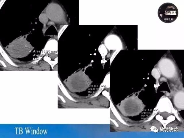 【PPT】周围型肺鳞癌的影像征象及鉴别诊断