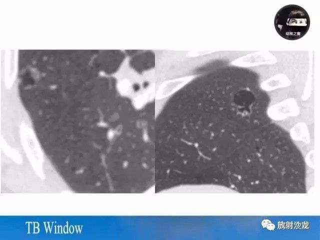 【PPT】周围型肺鳞癌的影像征象及鉴别诊断