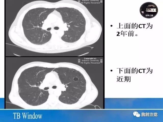 【PPT】周围型肺鳞癌的影像征象及鉴别诊断