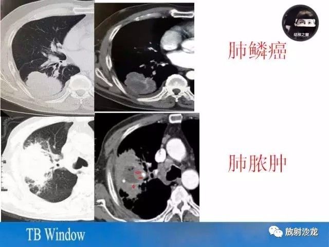 【PPT】周围型肺鳞癌的影像征象及鉴别诊断