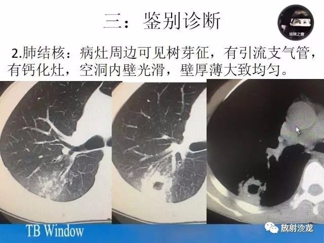 【PPT】周围型肺鳞癌的影像征象及鉴别诊断