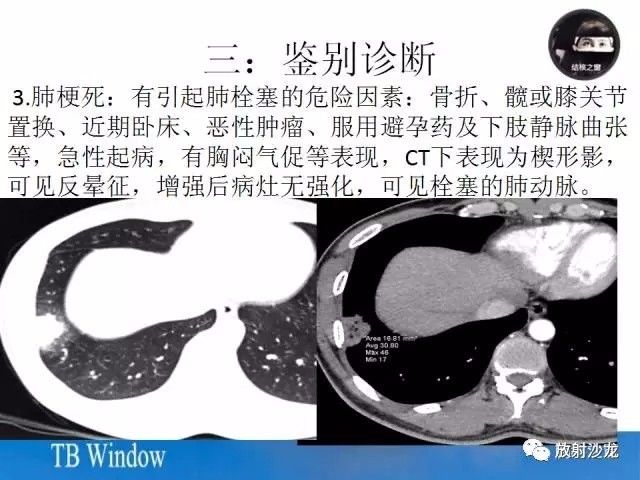 【PPT】周围型肺鳞癌的影像征象及鉴别诊断