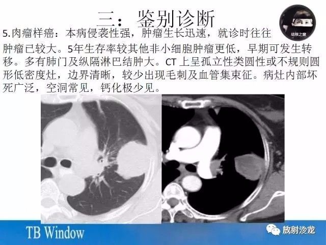 【PPT】周围型肺鳞癌的影像征象及鉴别诊断