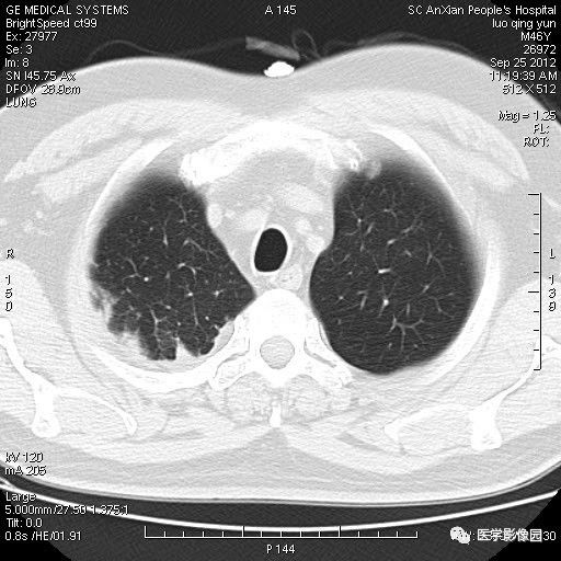 【病例】右上肺炎性假瘤1例CT影像表现 【病例】右上肺炎性假瘤1例CT影像表现