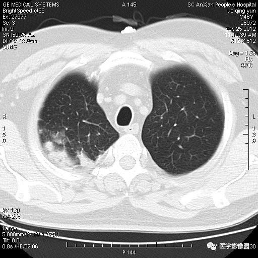 【病例】右上肺炎性假瘤1例CT影像表现 【病例】右上肺炎性假瘤1例CT影像表现
