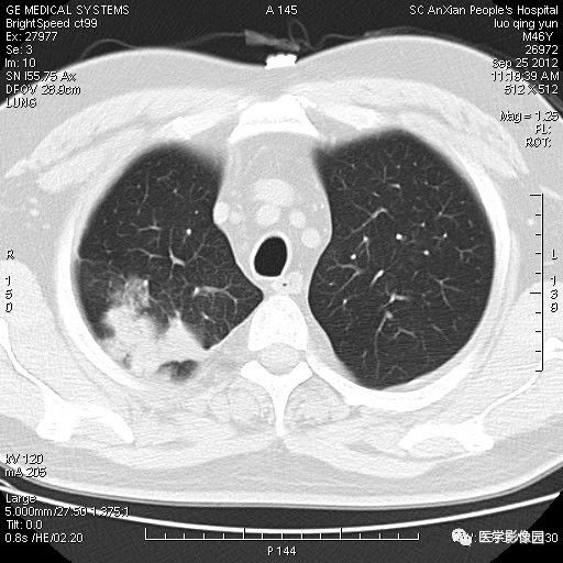 【病例】右上肺炎性假瘤1例CT影像表现 【病例】右上肺炎性假瘤1例CT影像表现