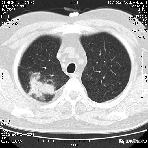 【病例】右上肺炎性假瘤1例CT影像表现 【病例】右上肺炎性假瘤1例CT影像表现