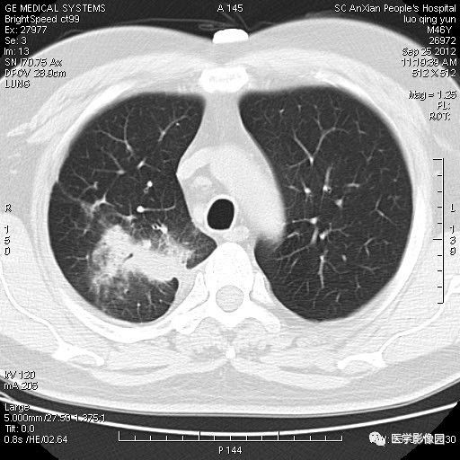 【病例】右上肺炎性假瘤1例CT影像表现 【病例】右上肺炎性假瘤1例CT影像表现