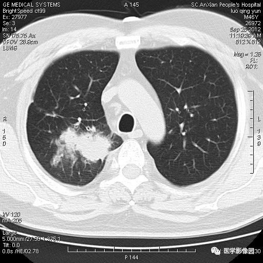 【病例】右上肺炎性假瘤1例CT影像表现 【病例】右上肺炎性假瘤1例CT影像表现
