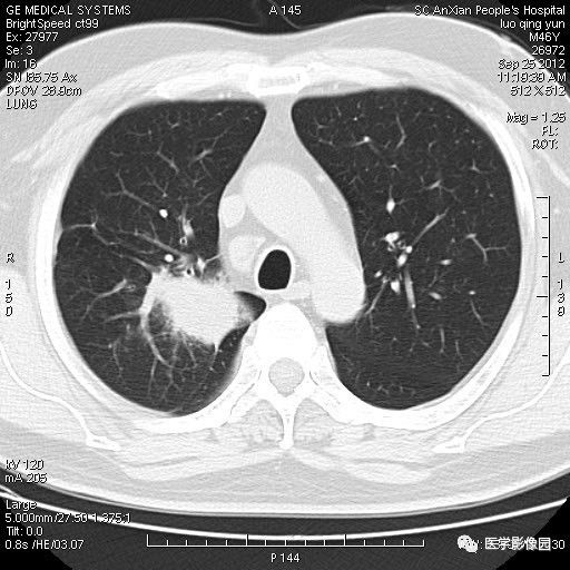 【病例】右上肺炎性假瘤1例CT影像表现 【病例】右上肺炎性假瘤1例CT影像表现