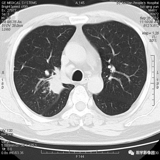 【病例】右上肺炎性假瘤1例CT影像表现 【病例】右上肺炎性假瘤1例CT影像表现