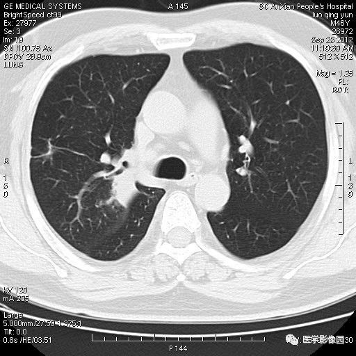 【病例】右上肺炎性假瘤1例CT影像表现 【病例】右上肺炎性假瘤1例CT影像表现