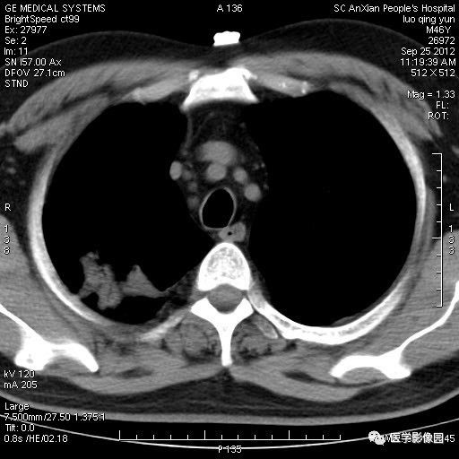 【病例】右上肺炎性假瘤1例CT影像表现 【病例】右上肺炎性假瘤1例CT影像表现