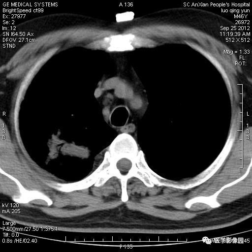 【病例】右上肺炎性假瘤1例CT影像表现 【病例】右上肺炎性假瘤1例CT影像表现