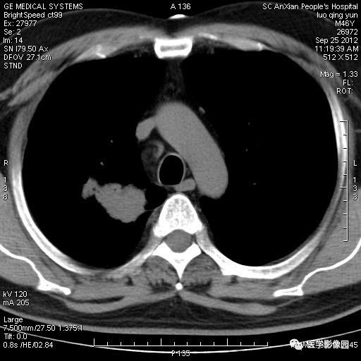 【病例】右上肺炎性假瘤1例CT影像表现 【病例】右上肺炎性假瘤1例CT影像表现