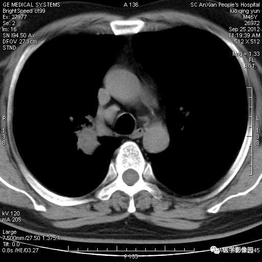【病例】右上肺炎性假瘤1例CT影像表现 【病例】右上肺炎性假瘤1例CT影像表现