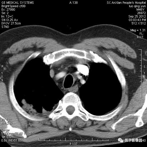 【病例】右上肺炎性假瘤1例CT影像表现 【病例】右上肺炎性假瘤1例CT影像表现