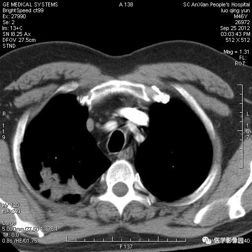 【病例】右上肺炎性假瘤1例CT影像表现 【病例】右上肺炎性假瘤1例CT影像表现