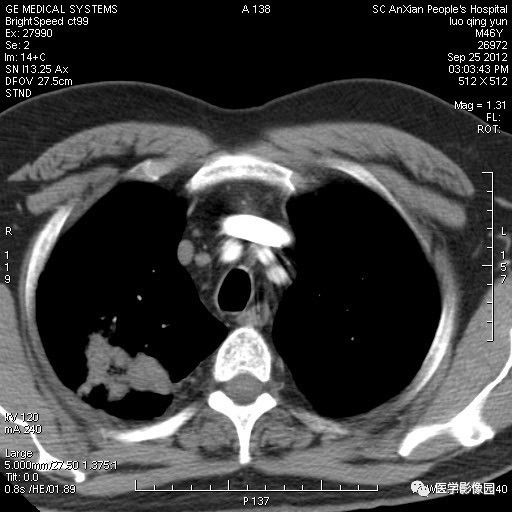 【病例】右上肺炎性假瘤1例CT影像表现 【病例】右上肺炎性假瘤1例CT影像表现