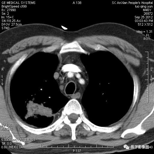 【病例】右上肺炎性假瘤1例CT影像表现 【病例】右上肺炎性假瘤1例CT影像表现