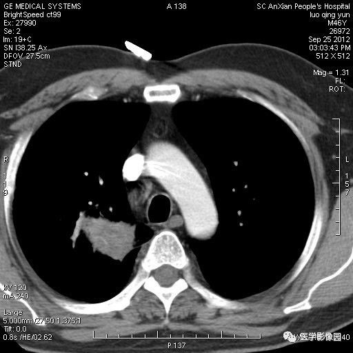 【病例】右上肺炎性假瘤1例CT影像表现 【病例】右上肺炎性假瘤1例CT影像表现