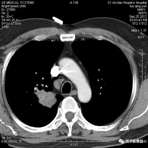 【病例】右上肺炎性假瘤1例CT影像表现 【病例】右上肺炎性假瘤1例CT影像表现