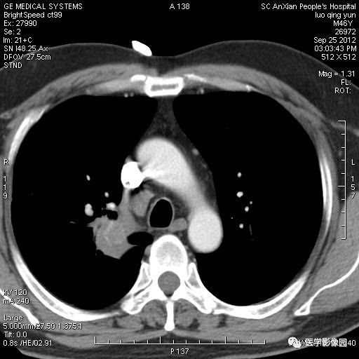 【病例】右上肺炎性假瘤1例CT影像表现 【病例】右上肺炎性假瘤1例CT影像表现