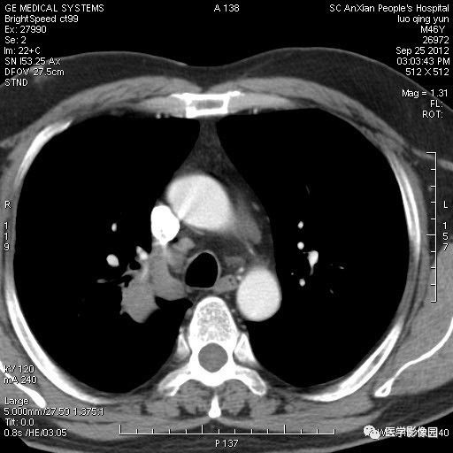 【病例】右上肺炎性假瘤1例CT影像表现 【病例】右上肺炎性假瘤1例CT影像表现