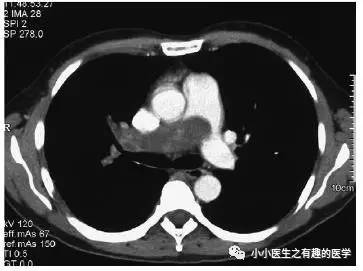 肺动脉充盈缺损不一定是血栓—学习被老外误诊误治的肺栓塞