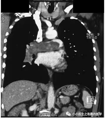 肺动脉充盈缺损不一定是血栓—学习被老外误诊误治的肺栓塞