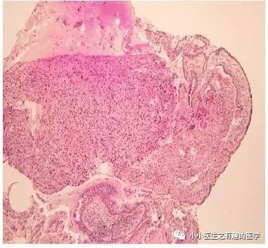 肺动脉充盈缺损不一定是血栓—学习被老外误诊误治的肺栓塞