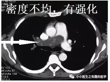 肺动脉充盈缺损不一定是血栓—学习被老外误诊误治的肺栓塞